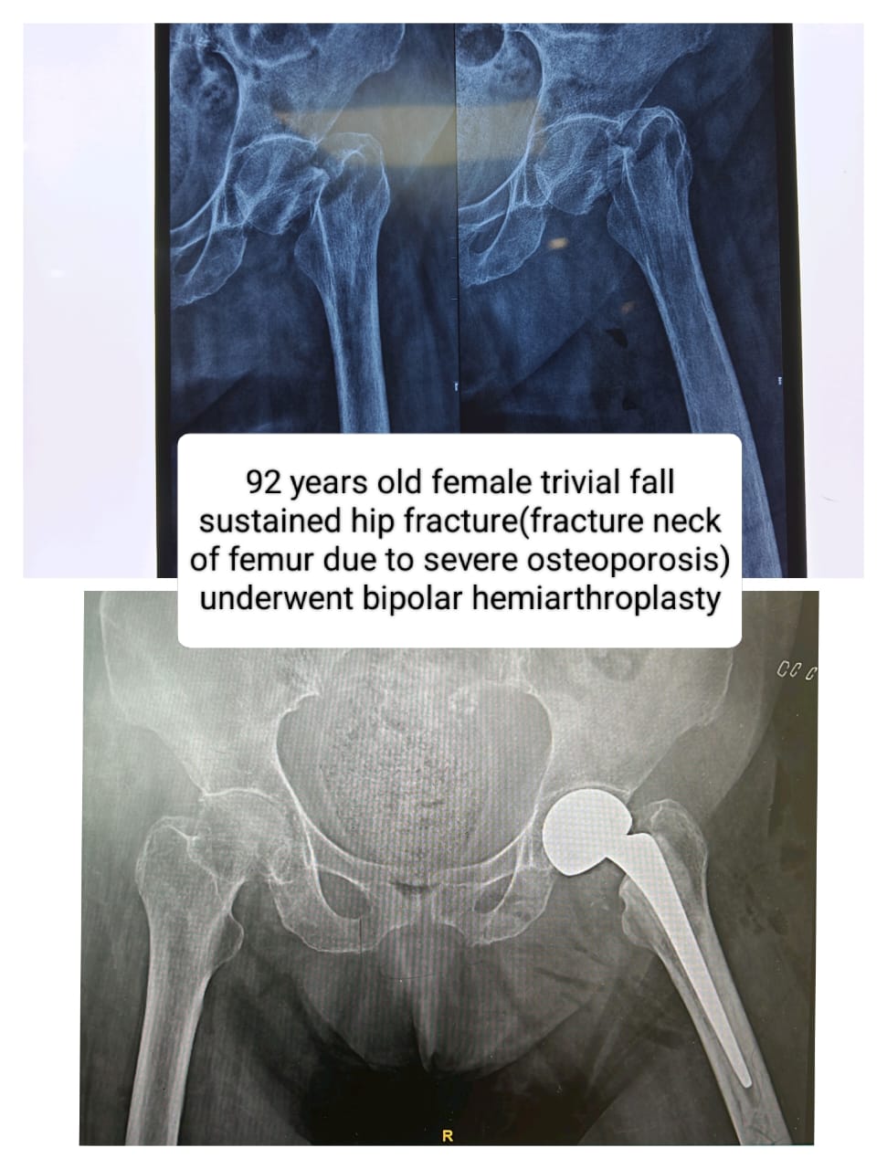 Osteoporotic neck of femur fracture case study