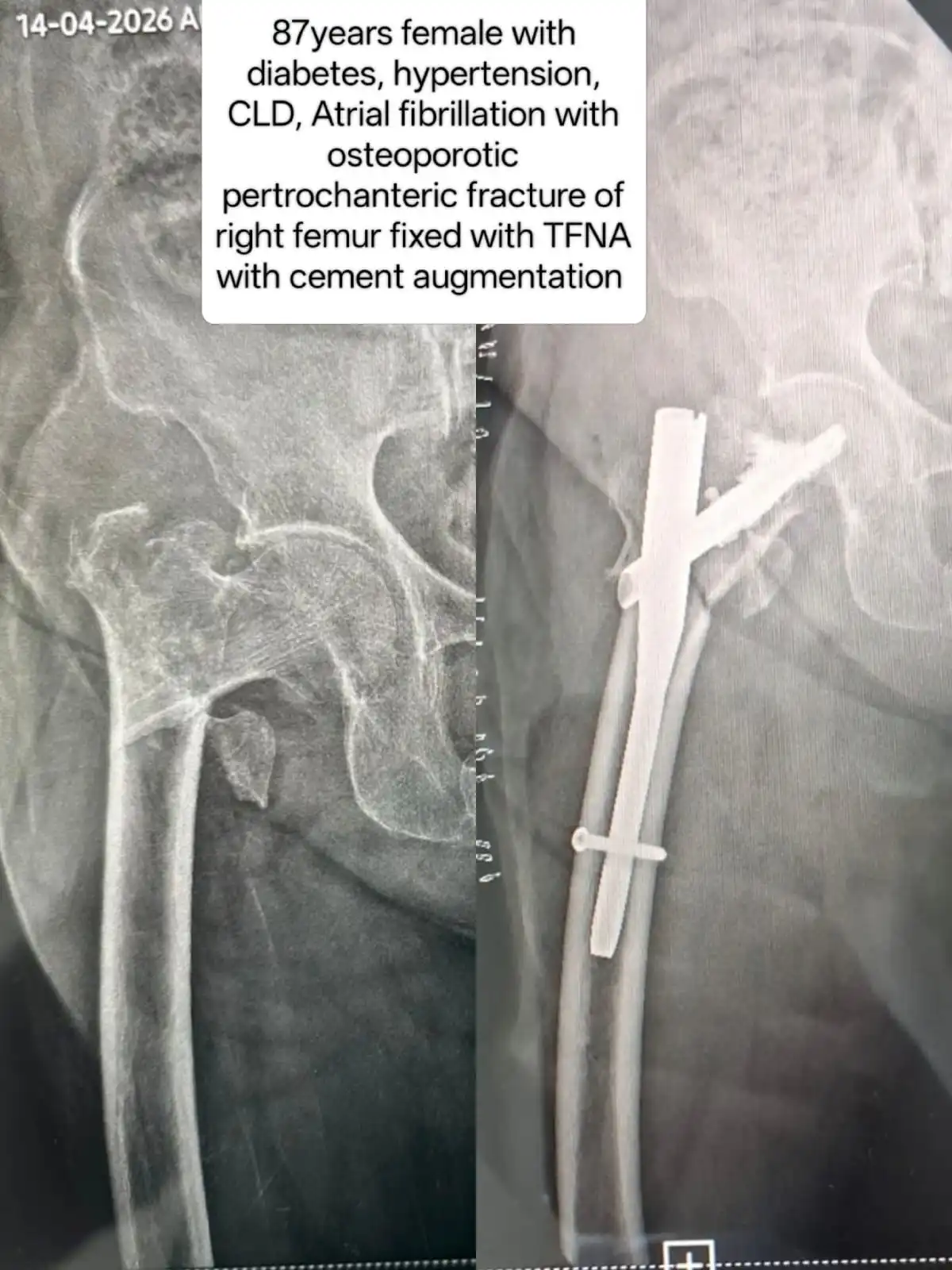 Osteoporotic pertrochanteric femur fracture case study