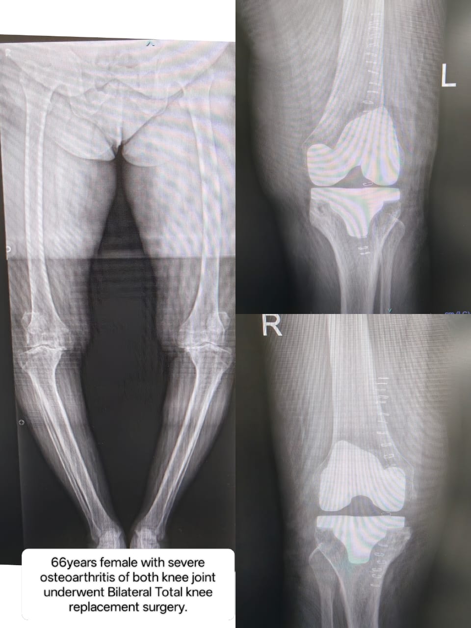 Successful bilateral total knee replacement surgery case study
