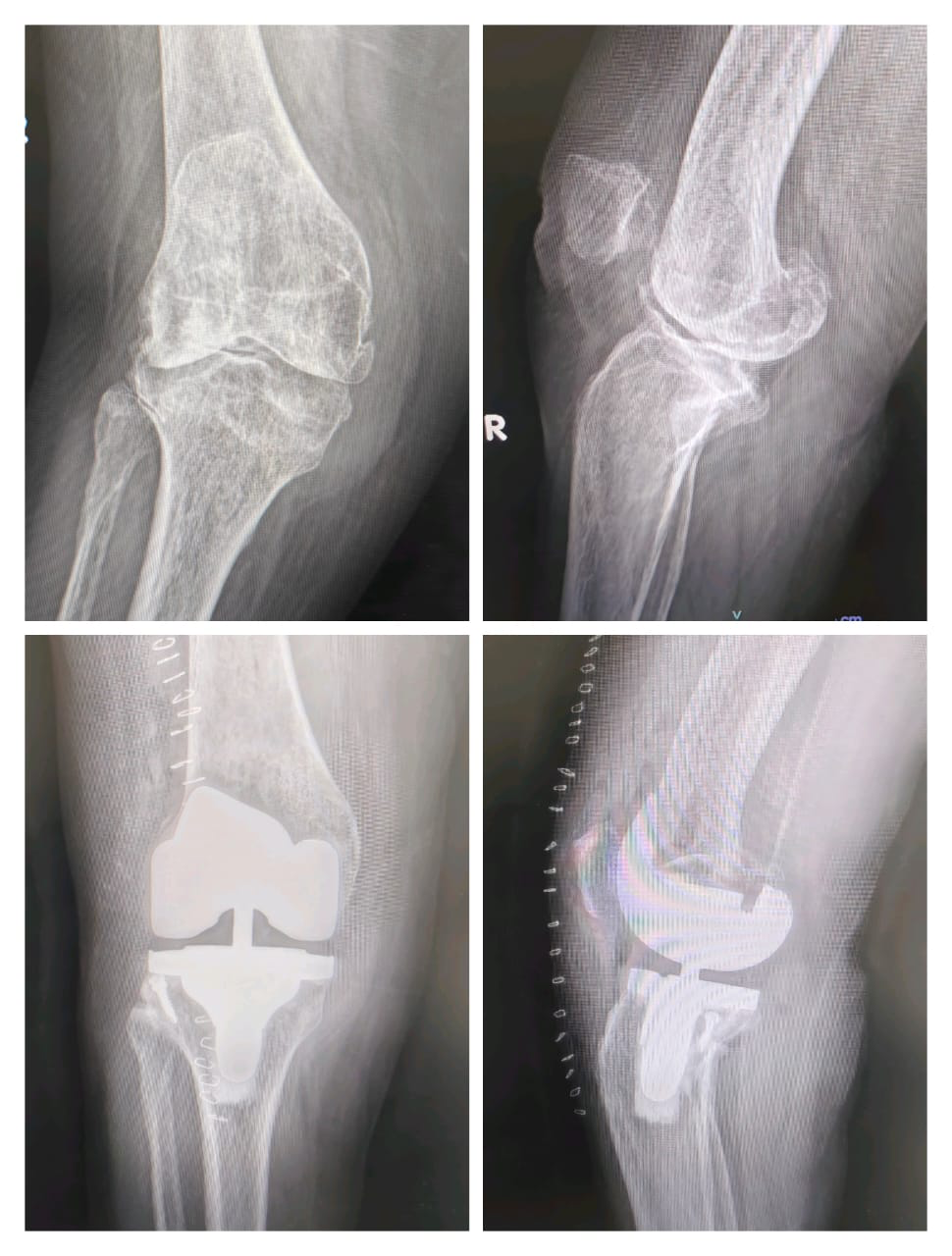 Primary total knee replacement surgery case study