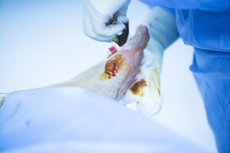 Partial Knee Replacement (PKR)